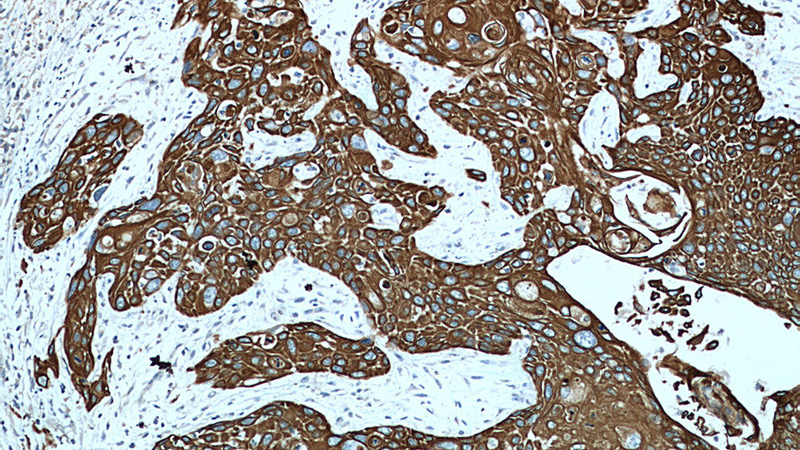 Immunohistochemistry of paraffin-embedded human oesophagus cancer tissue slide using Catalog No:107230(KRT15 Antibody) at dilution of 1:500 (under 10x lens).