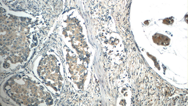 Immunohistochemistry of paraffin-embedded human breast cancer tissue slide using Catalog No:107180(c-SRC Antibody) at dilution of 1:50 (under 10x lens)