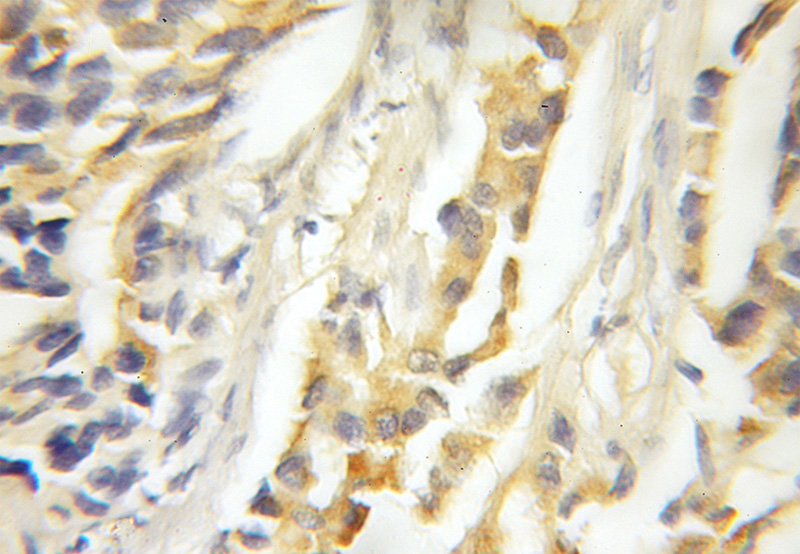 Immunohistochemical of paraffin-embedded human prostate cancer using Catalog No:112443(MAPKSP1 antibody) at dilution of 1:50 (under 10x lens)