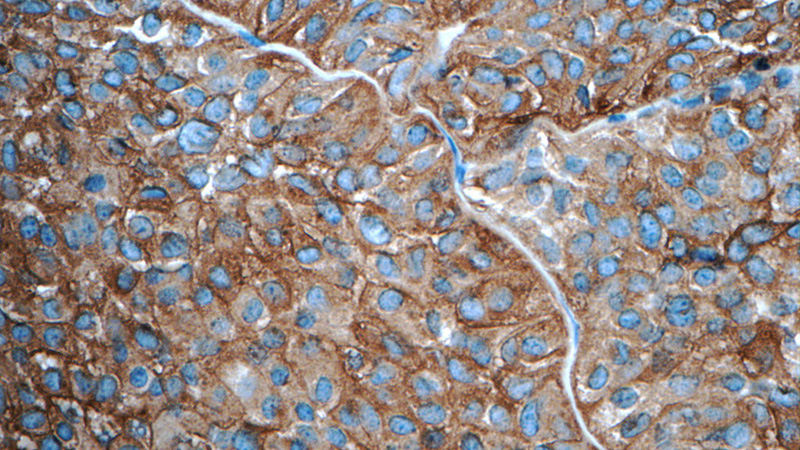 Immunohistochemistry of paraffin-embedded human pituitary adenoma tissue slide using Catalog No:115768(Synaptophysin; SYP Antibody) at dilution of 1:50 (under 40x lens)