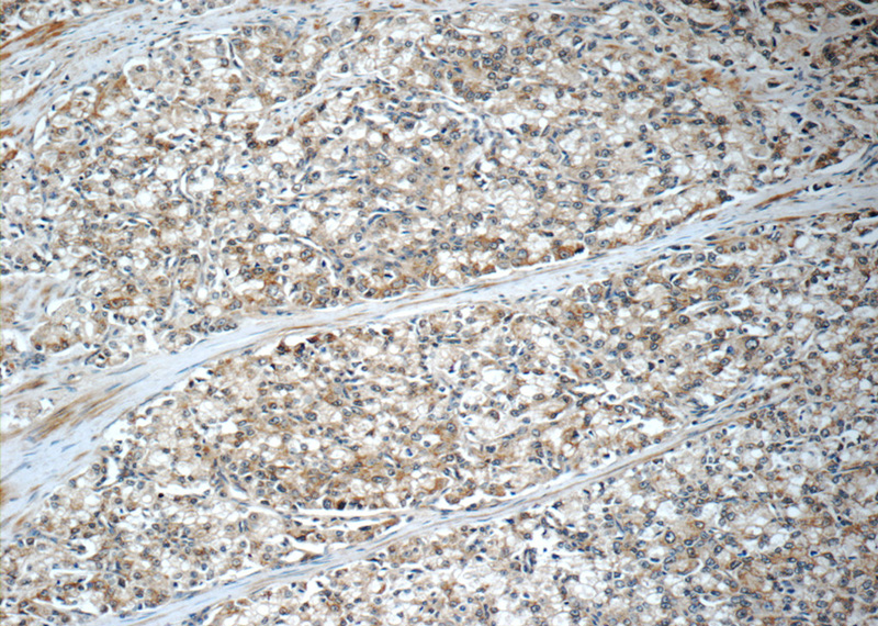 Immunohistochemistry of paraffin-embedded human prostate cancer tissue slide using Catalog No:108698(C20orf195 Antibody) at dilution of 1:50 (under 10x lens)
