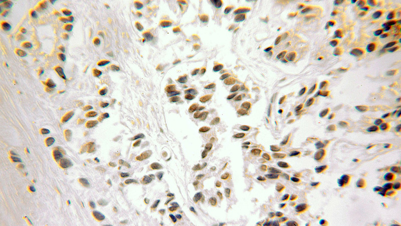 Immunohistochemical of paraffin-embedded human prostate cancer using Catalog No:110789(FUBP3 antibody) at dilution of 1:100 (under 25x lens)