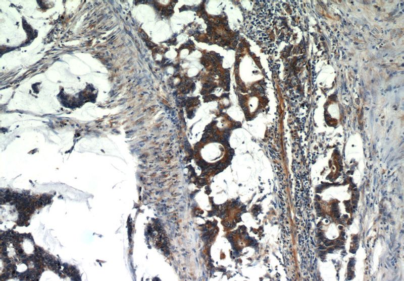 Immunohistochemistry of paraffin-embedded human colon cancer slide using Catalog No:112300(LPCAT1 Antibody) at dilution of 1:100