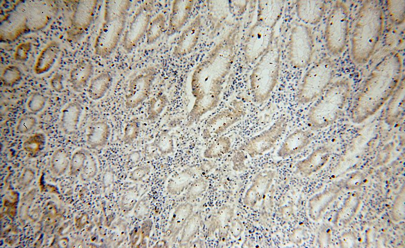 Immunohistochemical of paraffin-embedded human stomach cancer using Catalog No:113497(PAK1 antibody) at dilution of 1:100 (under 10x lens)