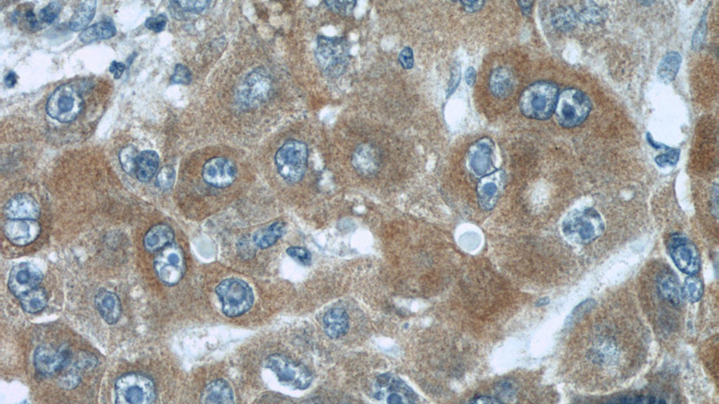 Immunohistochemical of paraffin-embedded human liver cancer using Catalog No:112670(BBS13 antibody) at dilution of 1:50 (under 40x lens)