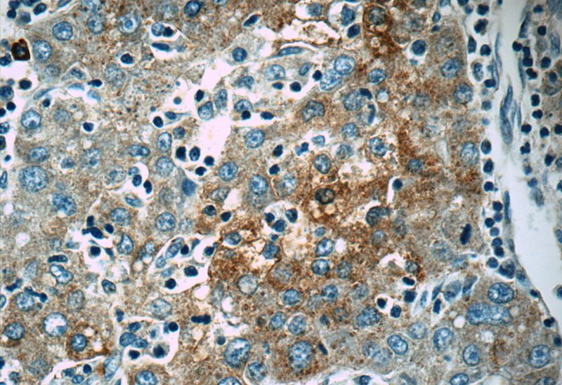 Immunohistochemistry of paraffin-embedded human liver cancer tissue slide using Catalog No:117074(ENPP2 Antibody) at dilution of 1:50 (under 40x lens)