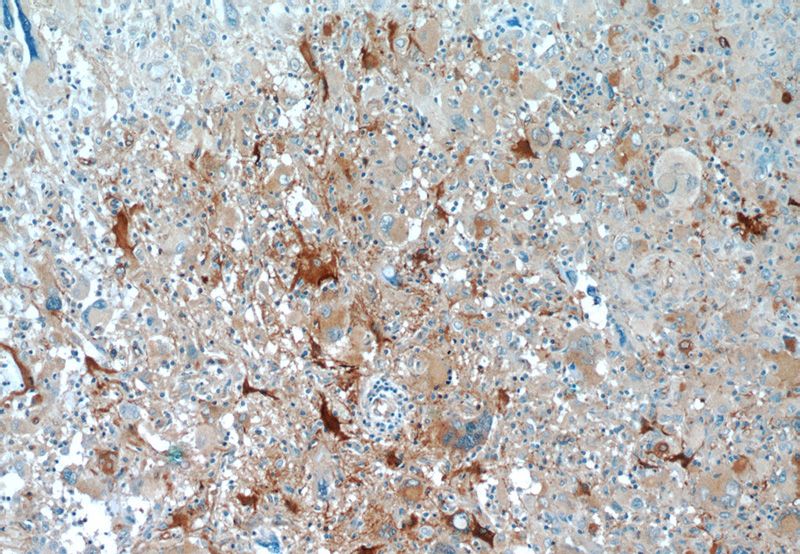 Immunohistochemistry of paraffin-embedded human gliomas tissue slide using Catalog No:108409(BAG3 Antibody) at dilution of 1:50 (under 10x lens)