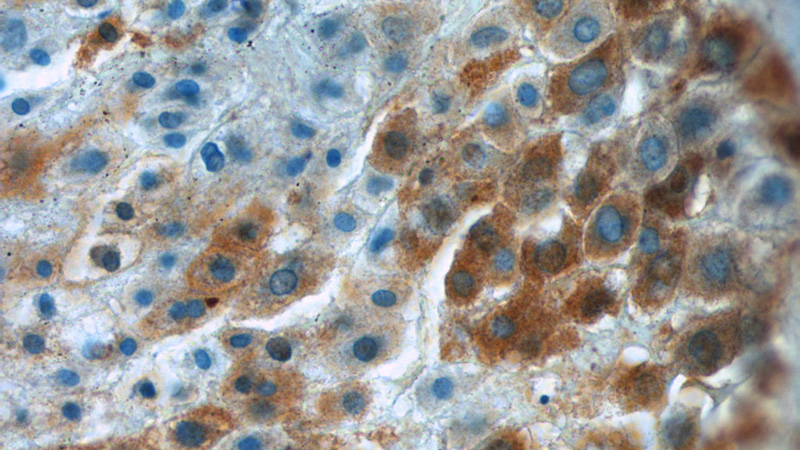 Immunohistochemistry of paraffin-embedded human placenta tissue slide using Catalog No:111683(IGFBP1 Antibody) at dilution of 1:50 (under 40x lens)