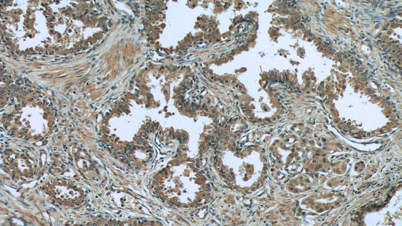 Immunohistochemistry of paraffin-embedded human prostate cancer tissue slide using Catalog No:110172(EIF1 Antibody) at dilution of 1:50 (under 10x lens)