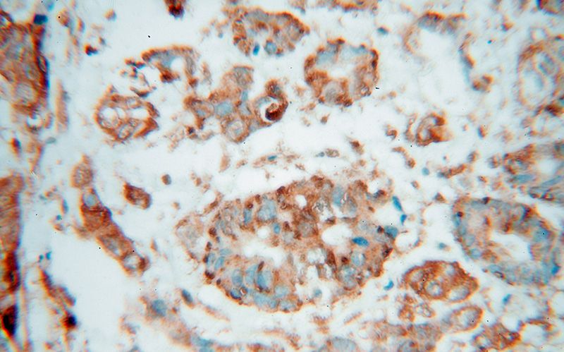 Immunohistochemical of paraffin-embedded human colon cancer using Catalog No:115655(SPTLC1 antibody) at dilution of 1:100 (under 40x lens)