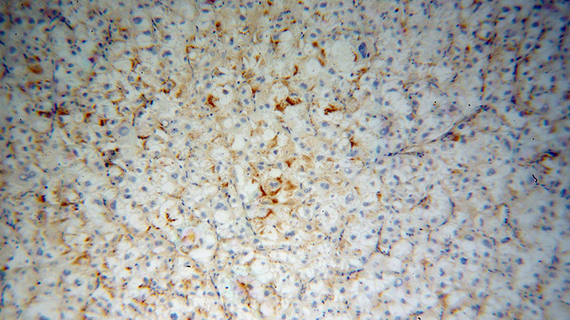 Immunohistochemical of paraffin-embedded human liver cancer using Catalog No:116238(TRAK2 antibody) at dilution of 1:100 (under 10x lens)