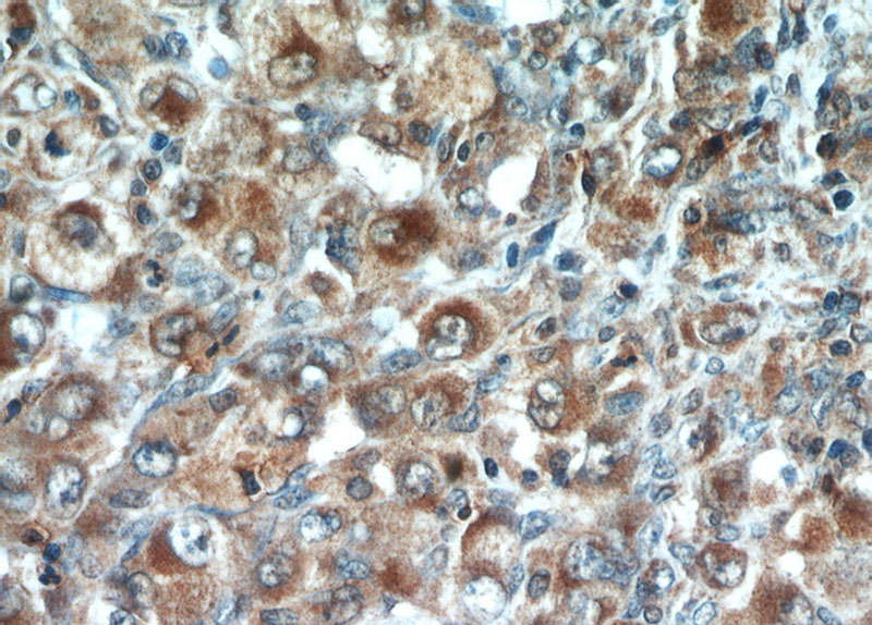 Immunohistochemical of paraffin-embedded human lymphoma using Catalog No:109123(SPN antibody) at dilution of 1:50 (under 40x lens)