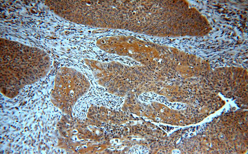 Immunohistochemical of paraffin-embedded human cervical cancer using Catalog No:116203(TMF1-Specific antibody) at dilution of 1:100 (under 10x lens)