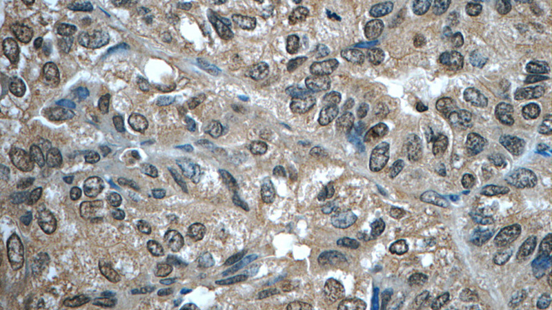 Immunohistochemistry of paraffin-embedded human breast cancer tissue slide using Catalog No:110422(EYA3 Antibody) at dilution of 1:50 (under 40x lens)