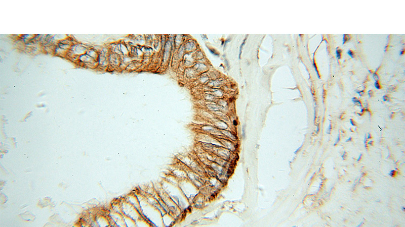 Immunohistochemical of paraffin-embedded human colon cancer using Catalog No:114681(REEP5 antibody) at dilution of 1:100 (under 40x lens)