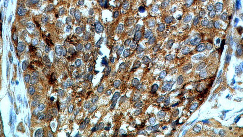 Immunohistochemical of paraffin-embedded human cervical cancer using Catalog No:108174(ARSA antibody) at dilution of 1:50 (under 40x lens)