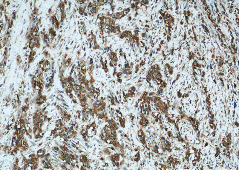 Immunohistochemical of paraffin-embedded human stomach cancer using Catalog No:113506(OPN, SPP1 antibody) at dilution of 1:50 (under 10x lens)
