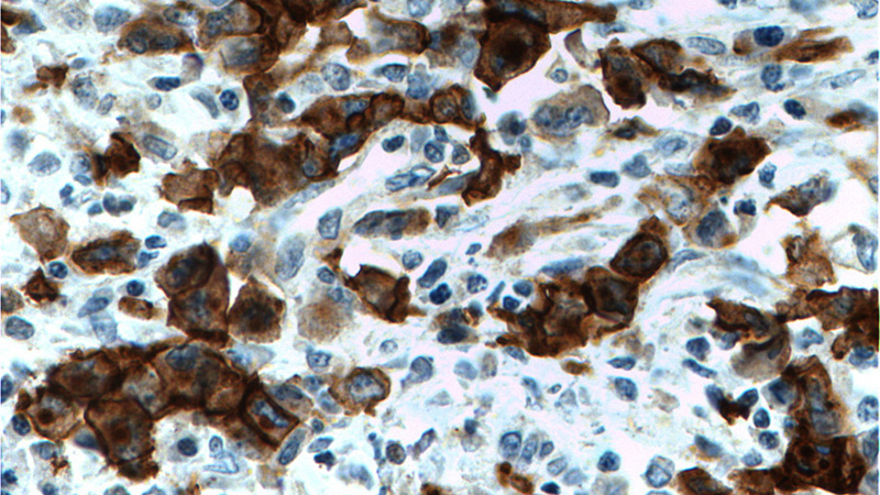 Immunohistochemistry of paraffin-embedded human T-cell anaplastic large cell lymphoma (ALCL) tissue slide using Catalog No:109022(TNFRSF8 Antibody) at dilution of 1:200 (under 40x lens). Heat mediated antigen retrieved with Tris-EDTA buffer(pH9).