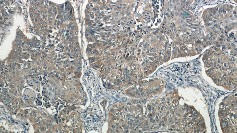 Immunohistochemistry of paraffin-embedded human lung cancer tissue slide using Catalog No:110962(GGT7 Antibody) at dilution of 1:50