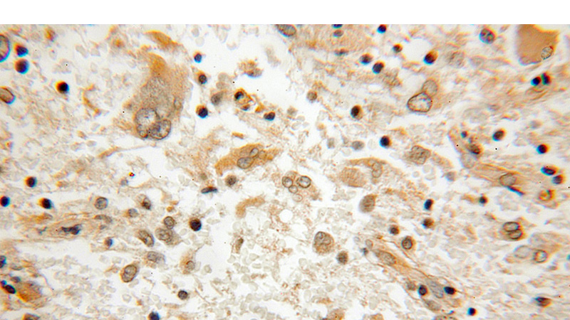 Immunohistochemical of paraffin-embedded human medulloblastoma using Catalog No:116781(VPS33B antibody) at dilution of 1:50 (under 10x lens)