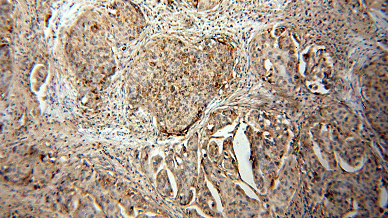 Immunohistochemical of paraffin-embedded human cervical cancer using Catalog No:115086(SEC61B antibody) at dilution of 1:50 (under 10x lens)