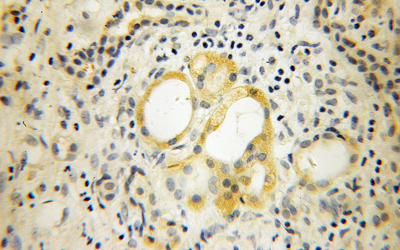 Immunohistochemical of paraffin-embedded human pancreas cancer using Catalog No:109894(DPT antibody) at dilution of 1:100 (under 40x lens)