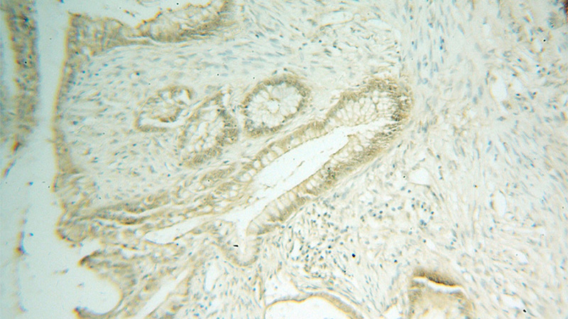 Immunohistochemical of paraffin-embedded human colon cancer using Catalog No:111476(HMG20B antibody) at dilution of 1:50 (under 10x lens)