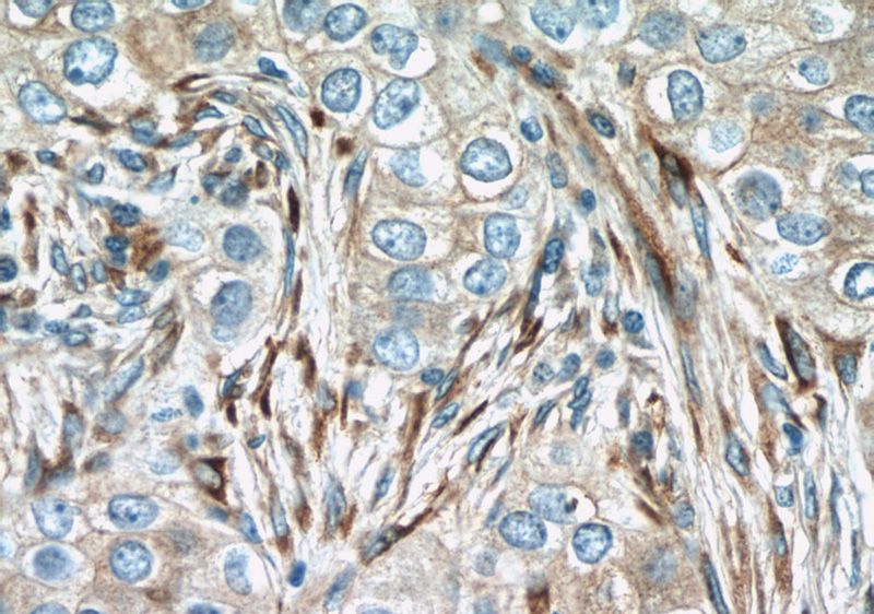 Immunohistochemistry of paraffin-embedded human breast cancer slide using Catalog No:111617(IFIT1 Antibody) at dilution of 1:50
