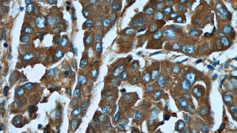 Immunohistochemistry of paraffin-embedded human liver cancer tissue slide using Catalog No:112364(MACC1 Antibody) at dilution of 1:50 (under 40x lens)