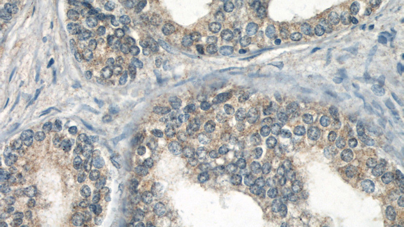 Immunohistochemical of paraffin-embedded human prostate hyperplasia using Catalog No:114021(PMEPA1 antibody) at dilution of 1:50 (under 40x lens)