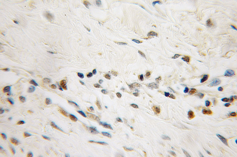 Immunohistochemical of paraffin-embedded human endometrial cancer using Catalog No:112896(MUM1 antibody) at dilution of 1:50 (under 10x lens)