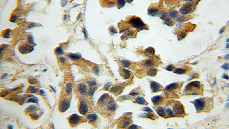 Immunohistochemical of paraffin-embedded human prostate cancer using Catalog No:110195(EIF3G antibody) at dilution of 1:50 (under 10x lens)