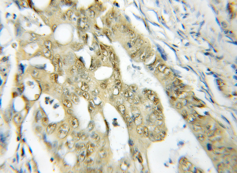 Immunohistochemical of paraffin-embedded human colon cancer using Catalog No:115605(SSB antibody) at dilution of 1:50 (under 10x lens)