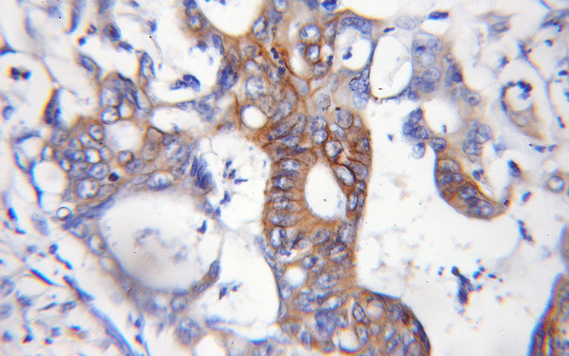 Immunohistochemical of paraffin-embedded human colon cancer using Catalog No:108219(ASCC2 antibody) at dilution of 1:100 (under 10x lens)