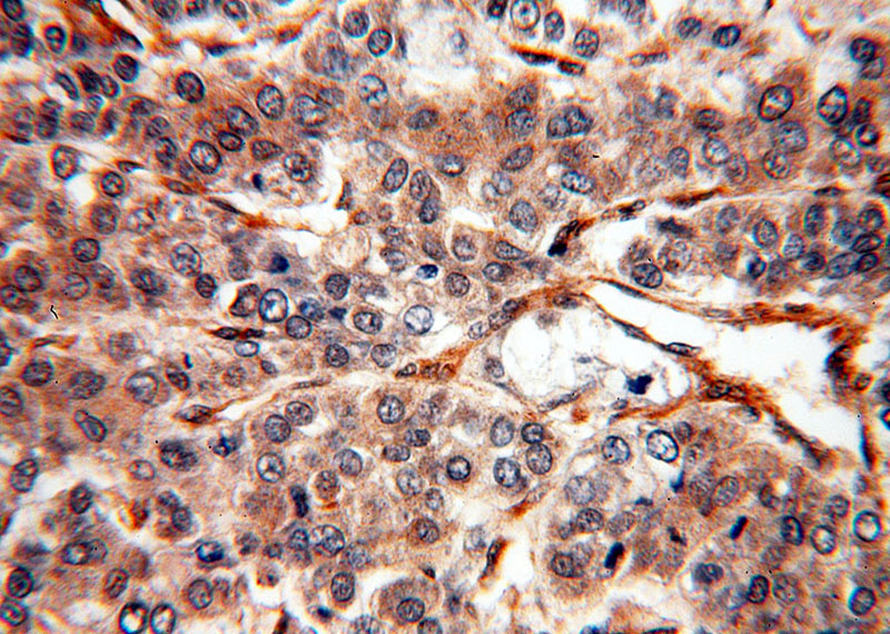 Immunohistochemical of paraffin-embedded human liver cancer using Catalog No:110348(EPHA1-special antibody) at dilution of 1:100 (under 40x lens)