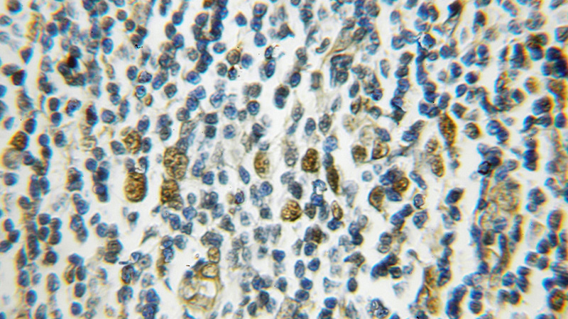Immunohistochemical of paraffin-embedded human lymphoma using Catalog No:111260(HAT1 antibody) at dilution of 1:50 (under 10x lens)