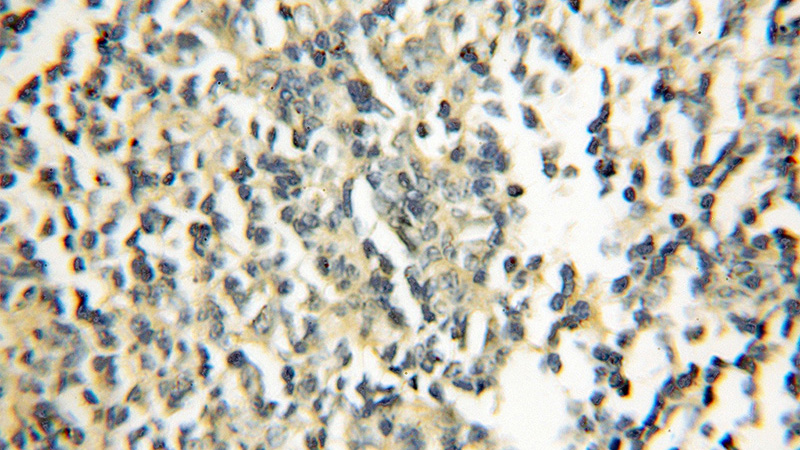 Immunohistochemical of paraffin-embedded human lymphoma using Catalog No:110974(GIMAP5 antibody) at dilution of 1:50 (under 10x lens)