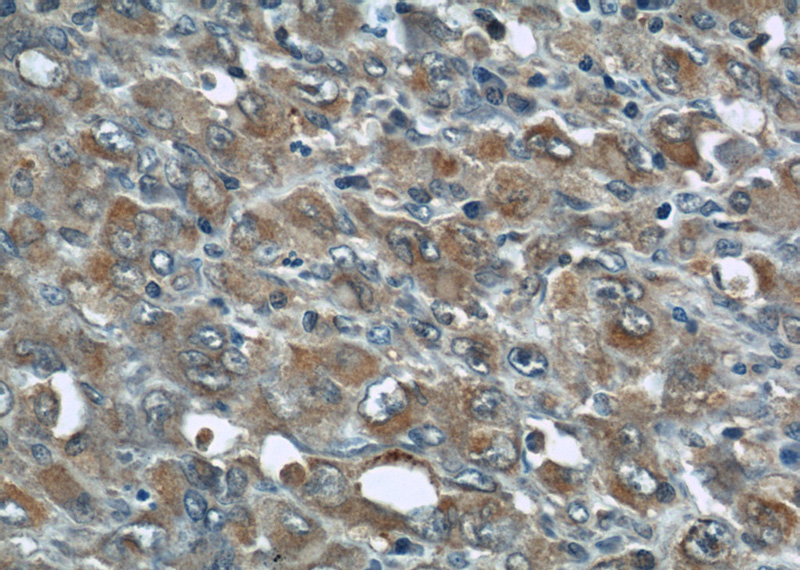 Immunohistochemical of paraffin-embedded human lymphoma using Catalog No:107546(ZAP70 antibody) at dilution of 1:50 (under 40x lens)