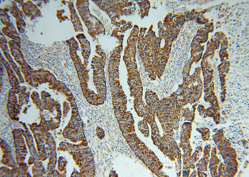 Immunohistochemical of paraffin-embedded human colon cancer using Catalog No:116373(TST antibody) at dilution of 1:50 (under 10x lens)