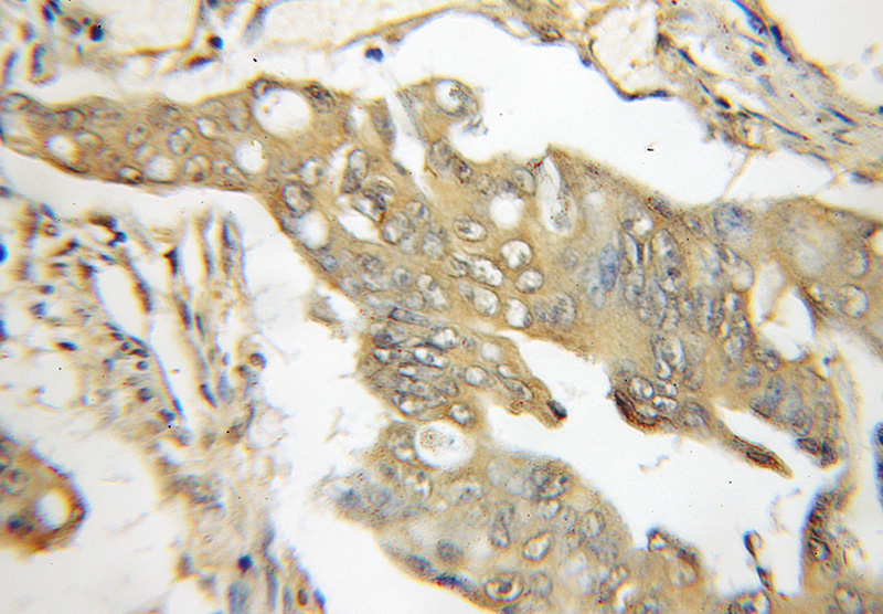Immunohistochemical of paraffin-embedded human colon cancer using Catalog No:116321(TRIM6 antibody) at dilution of 1:50 (under 10x lens)