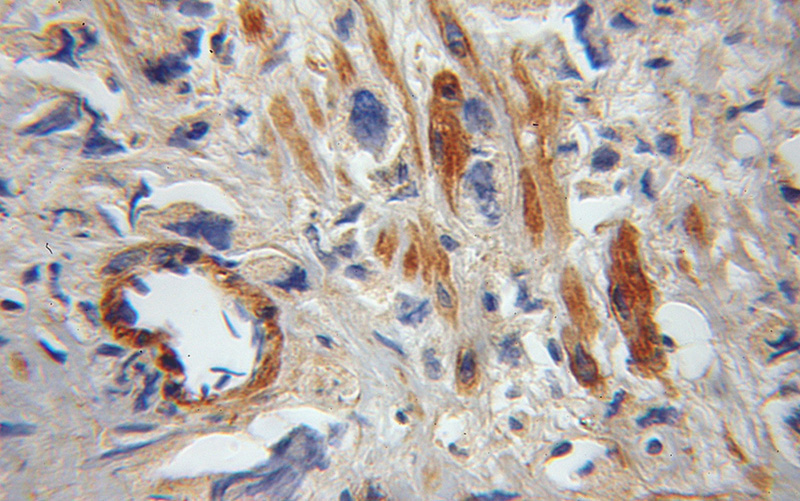 Immunohistochemical of paraffin-embedded human gliomas using Catalog No:110454(FAIM antibody) at dilution of 1:100 (under 10x lens)