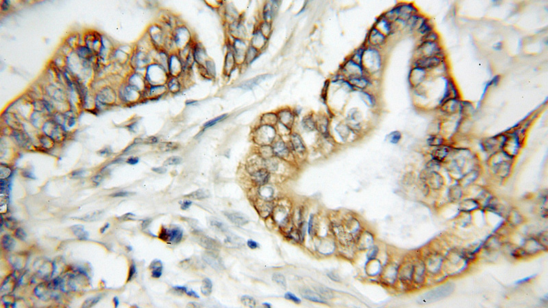 Immunohistochemical of paraffin-embedded human pancreas cancer using Catalog No:110369(ERO1L antibody) at dilution of 1:50 (under 10x lens)