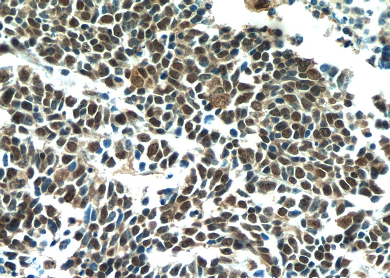Immunohistochemical of paraffin-embedded human lung cancer using Catalog No:107649(NKX2-1 antibody) at dilution of 1:50 (under 40x lens)