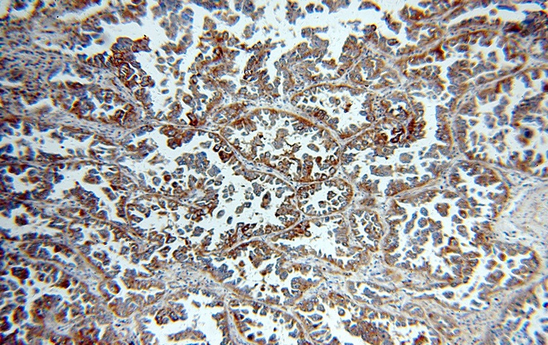 Immunohistochemical of paraffin-embedded human lung cancer using Catalog No:115194(SERINC3 antibody) at dilution of 1:50 (under 10x lens)
