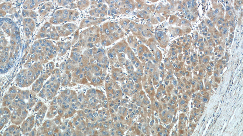 Immunohistochemical of paraffin-embedded human liver cancer using Catalog No:114005(PLOD2 antibody) at dilution of 1:50 (under 10x lens)