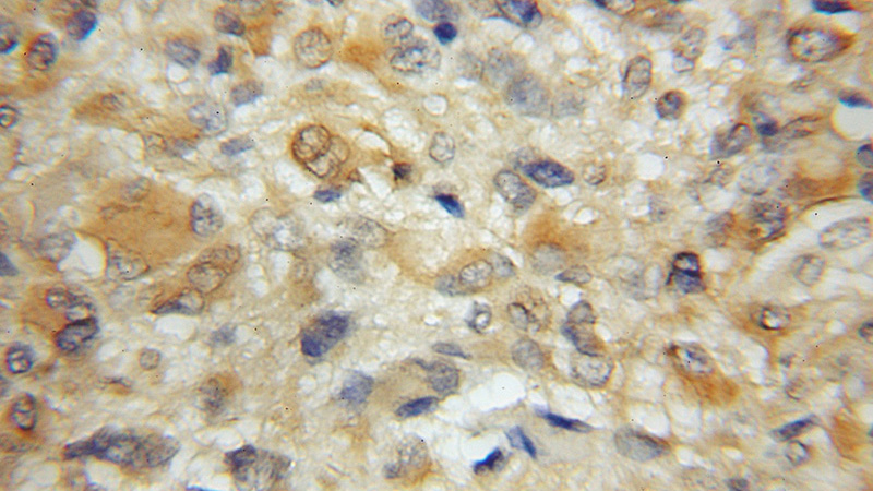 Immunohistochemical of paraffin-embedded human gliomas using Catalog No:115728(STMN4 antibody) at dilution of 1:50 (under 10x lens)