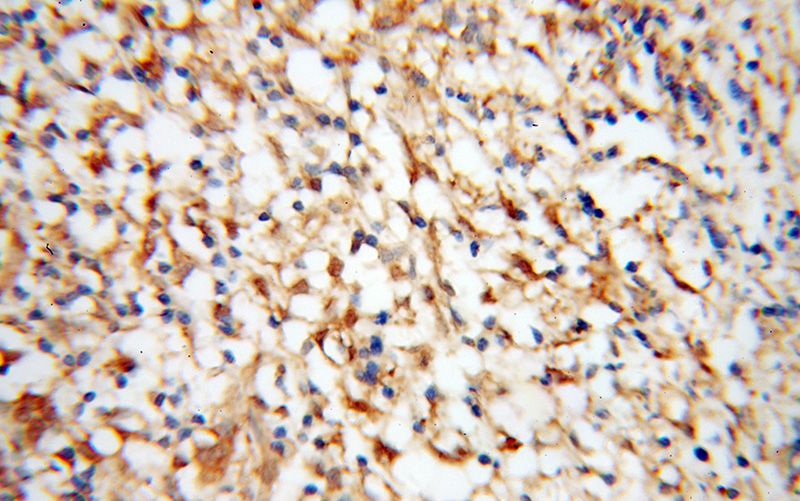 Immunohistochemical of paraffin-embedded human breast cancer using Catalog No:111837(IRF5 antibody) at dilution of 1:50 (under 40x lens)