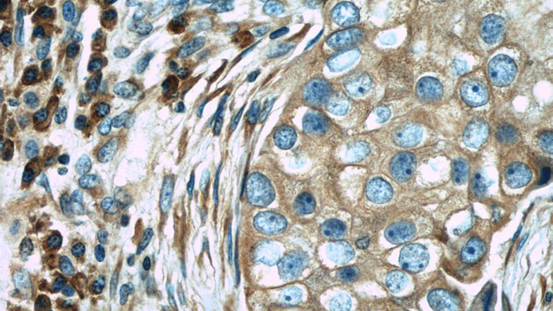 Immunohistochemical of paraffin-embedded human breast cancer using Catalog No:116340(TRAPB, SSR2 antibody) at dilution of 1:50 (under 40x lens)