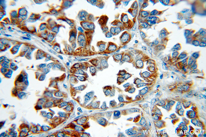 Immunohistochemical of paraffin-embedded human lung cancer using Catalog No:115194(SERINC3 antibody) at dilution of 1:50 (under 40x lens)