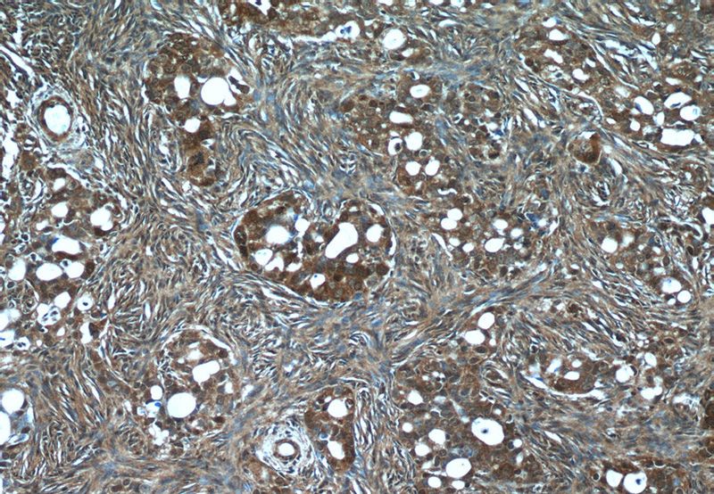 Immunohistochemistry of paraffin-embedded human ovary tumor tissue slide using Catalog No:114390(PSMC3 Antibody) at dilution of 1:50 (under 10x lens)